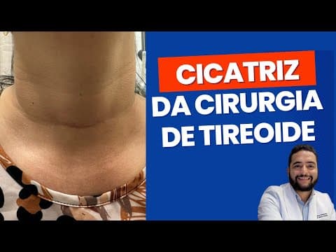 Cicatriz da cirurgia da tireoide
