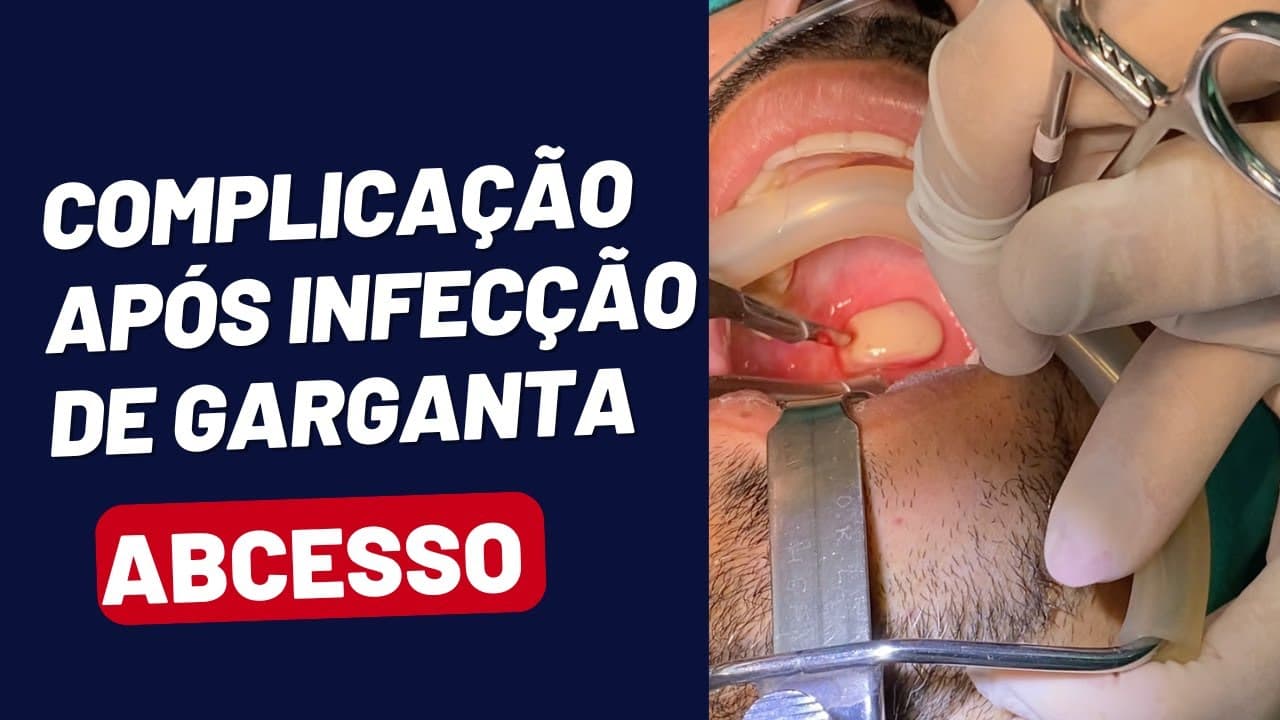 Complicação GRAVE de Infecção de Garganta - Abscesso Periamigdalino - Cirurgia