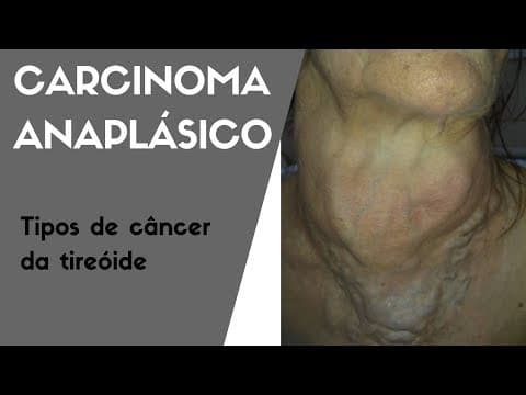 Carcinoma Anaplásico ou Indiferenciado - Tipos de câncer de tireóide | Dr Jônatas Catunda