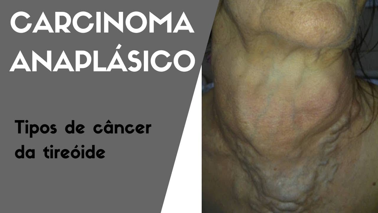 Carcinoma Anaplásico ou Indiferenciado - Tipos de câncer de tireóide | Dr Jônatas Catunda