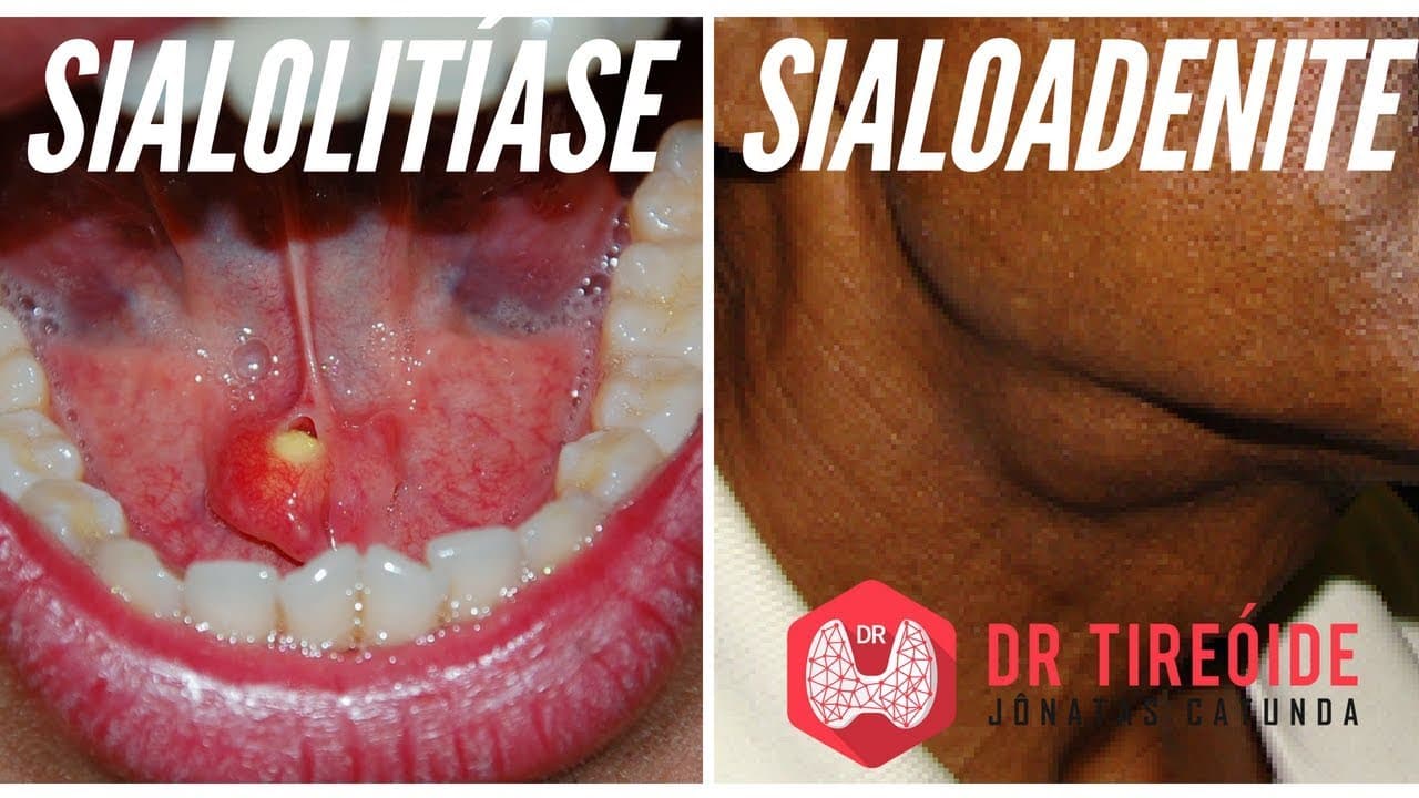 Sialolitíase e Sialoadenite | Dr Jônatas Catunda