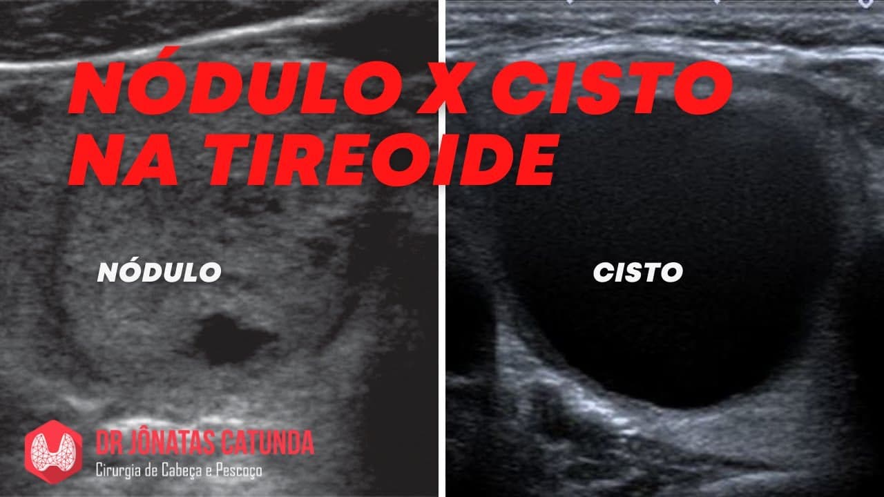 Nódulo e cisto na tireoide