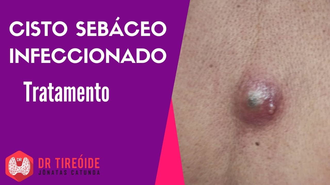 Cisto sebáceo infeccionado: drenagem e tratamento