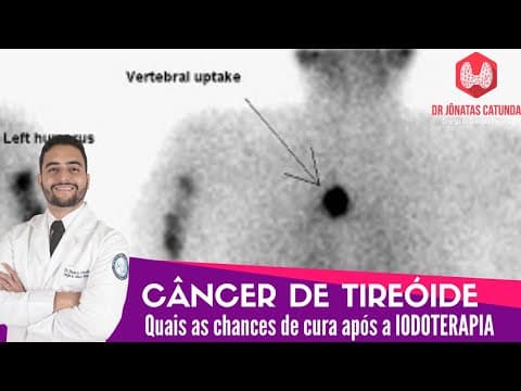 Quais as chances de cura do câncer de tireóide após a iodoterapia? Live Tudo Sobre Tireóide