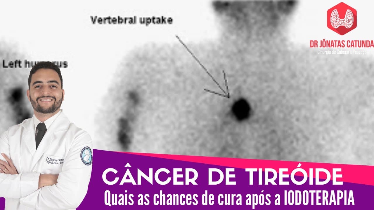 Quais as chances de cura do câncer de tireóide após a iodoterapia? Live Tudo Sobre Tireóide