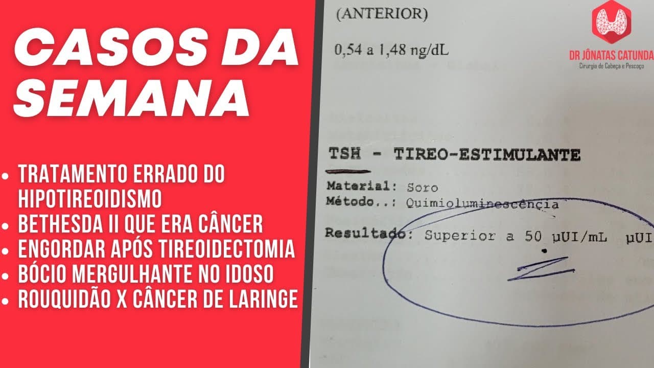 Casos da semana - Hipotireoidismo, Bócio mergulhante, Bethesda II maligno, Peso X TT,