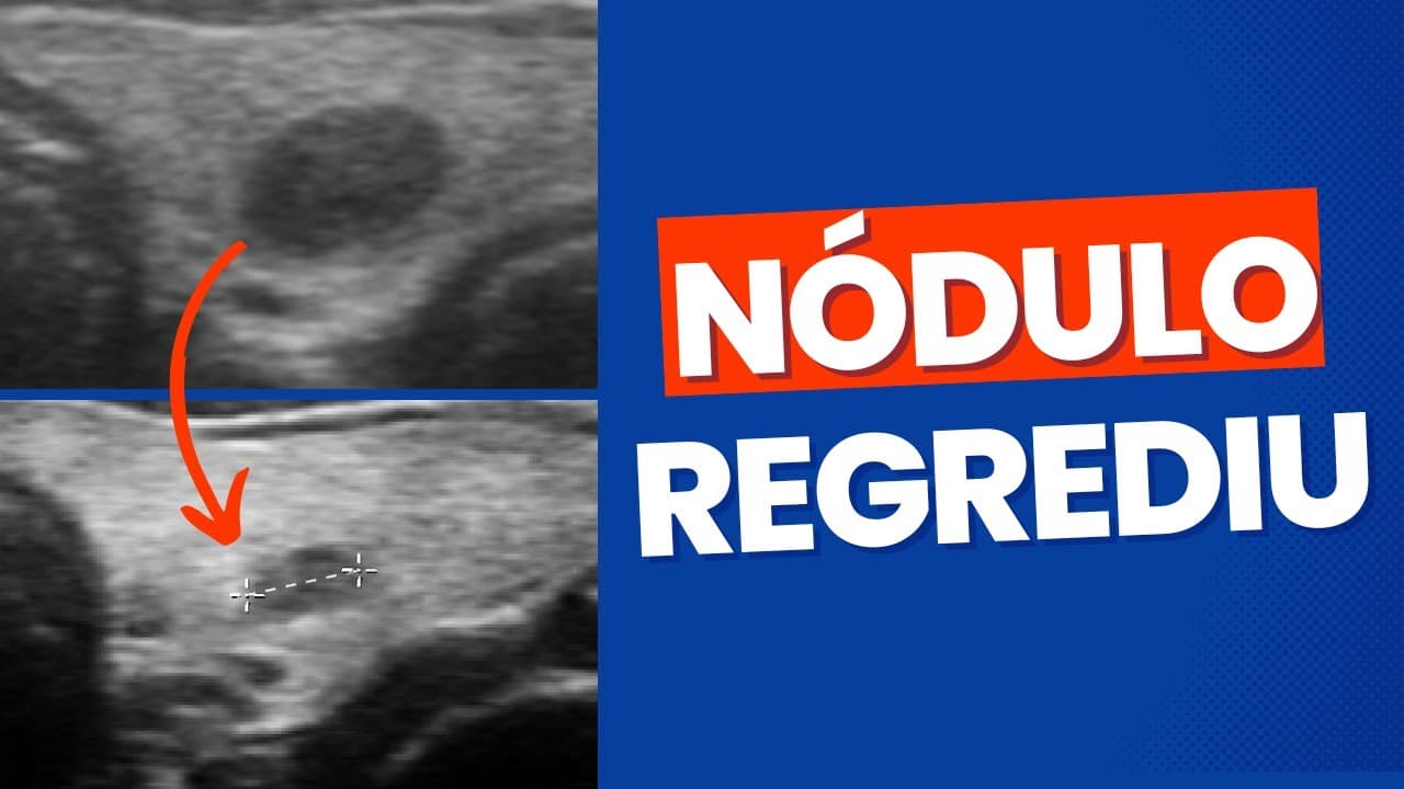 Nódulo na tireóide que regrediu de tamanho