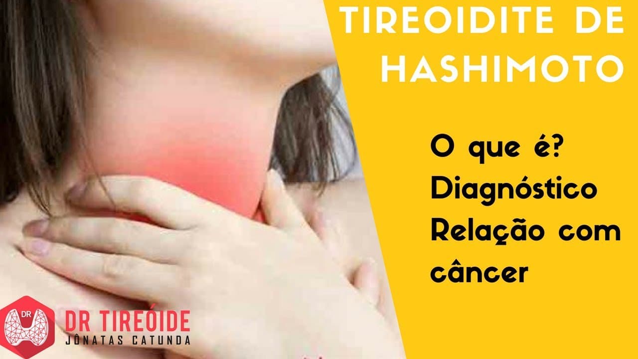 Tireoidite de Hashimoto e o Hipotireoidismo | Dr Jônatas Catunda