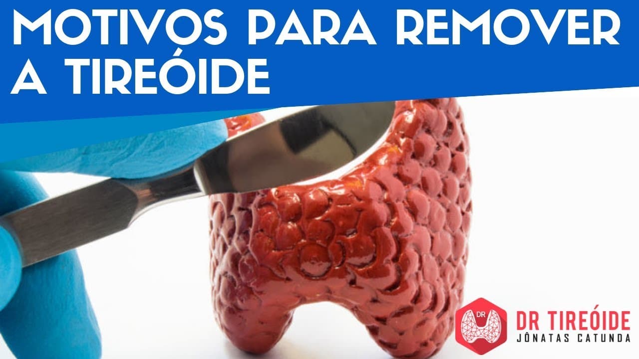 Motivos para remover a tireóide - Dr Tireóide Responde