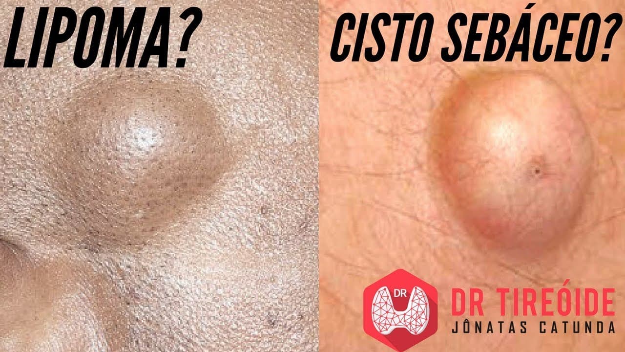 Lipoma? Cisto sebáceo? Saiba o que são e qual o tratamento! | Dr Jônatas Catunda