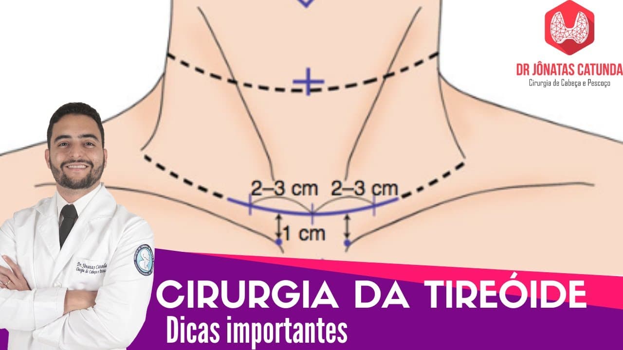 Tireoidectomia - Dicas importantes! (anestesia, duração, drenos, cicatriz, complicações)