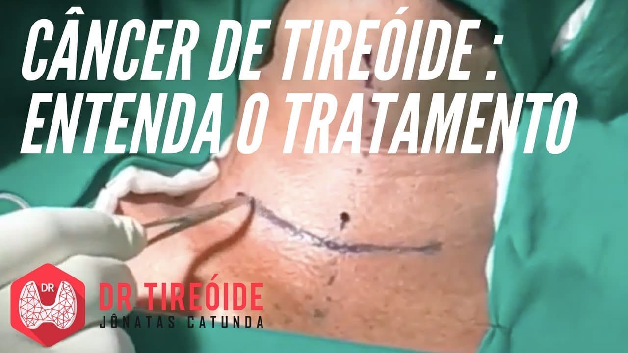 Tratamento do câncer de tireóide | Dr Jônatas Catunda