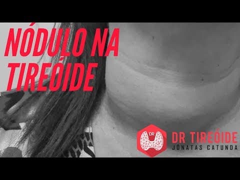 O que você precisa saber sobre nódulo na tireóide | Dr Jônatas Catunda
