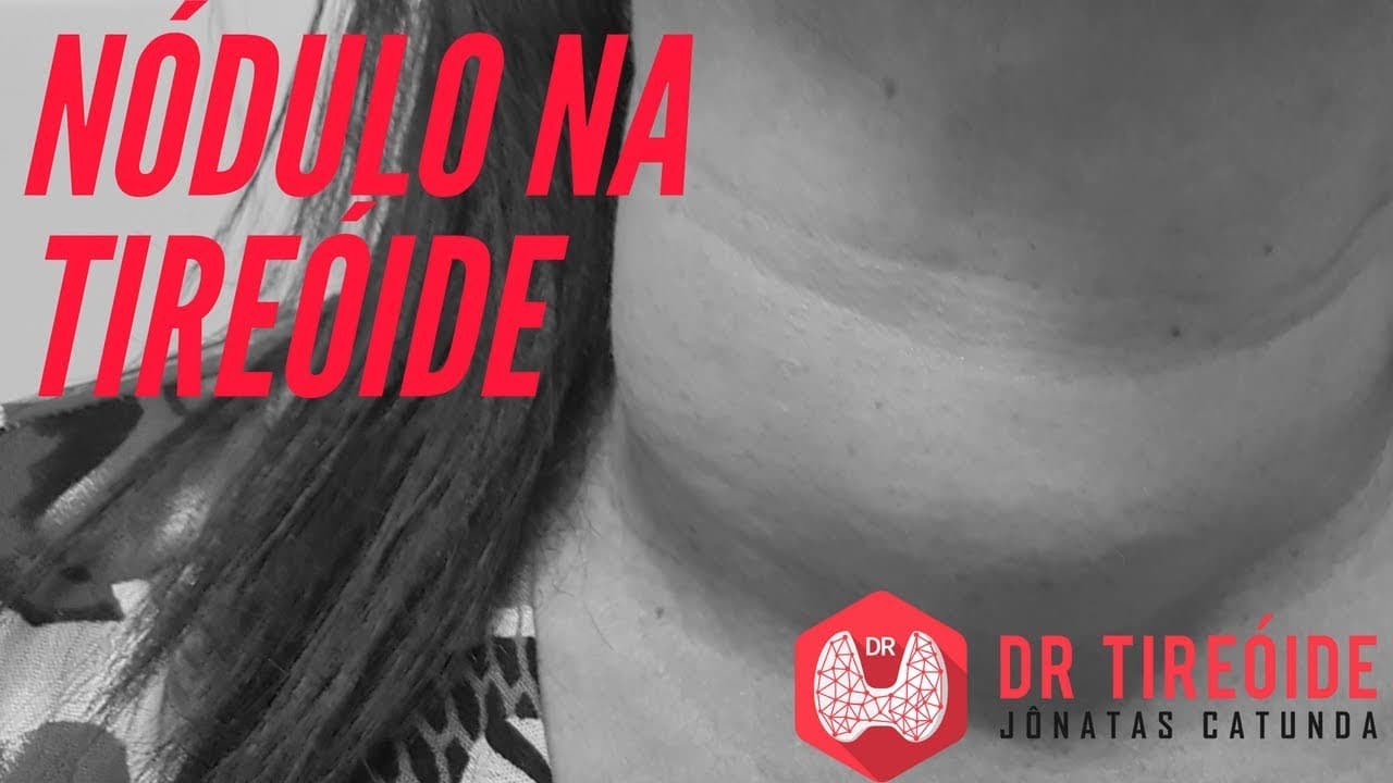 O que você precisa saber sobre nódulo na tireóide | Dr Jônatas Catunda