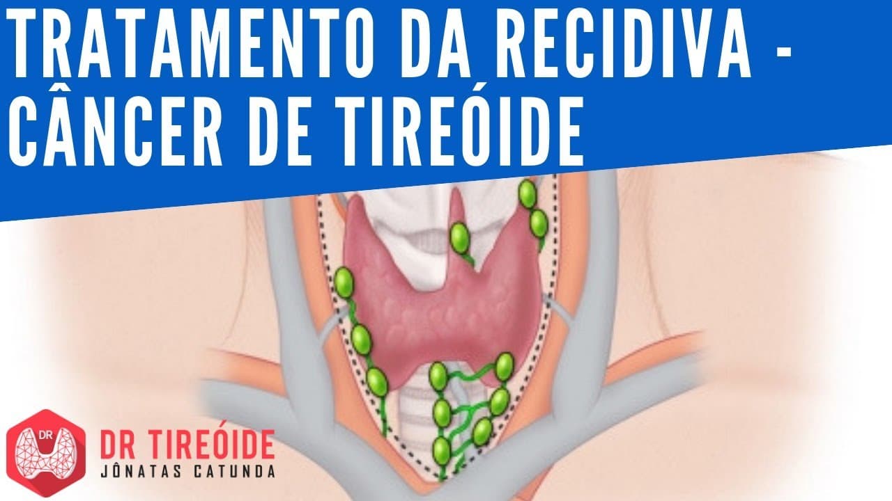 Tratamento da recidiva do câncer de tireóide | Dr Tireóide Responde