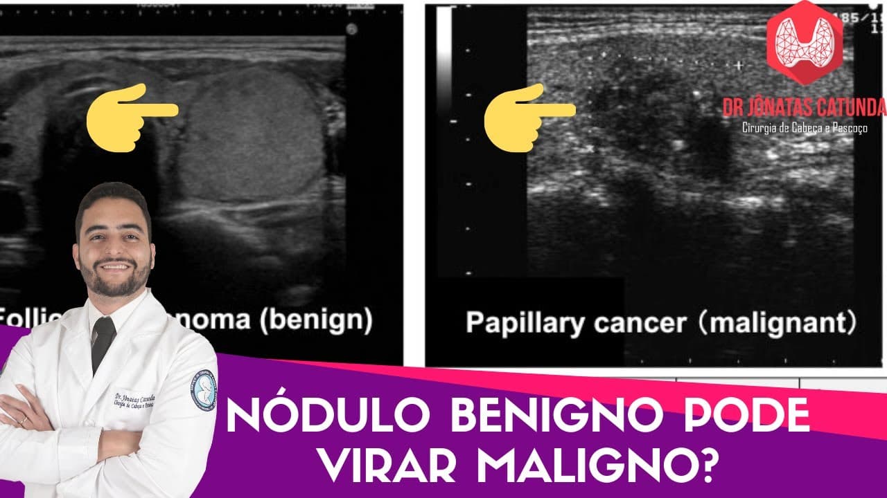 Nódulo na tireóide benigno pode virar maligno?