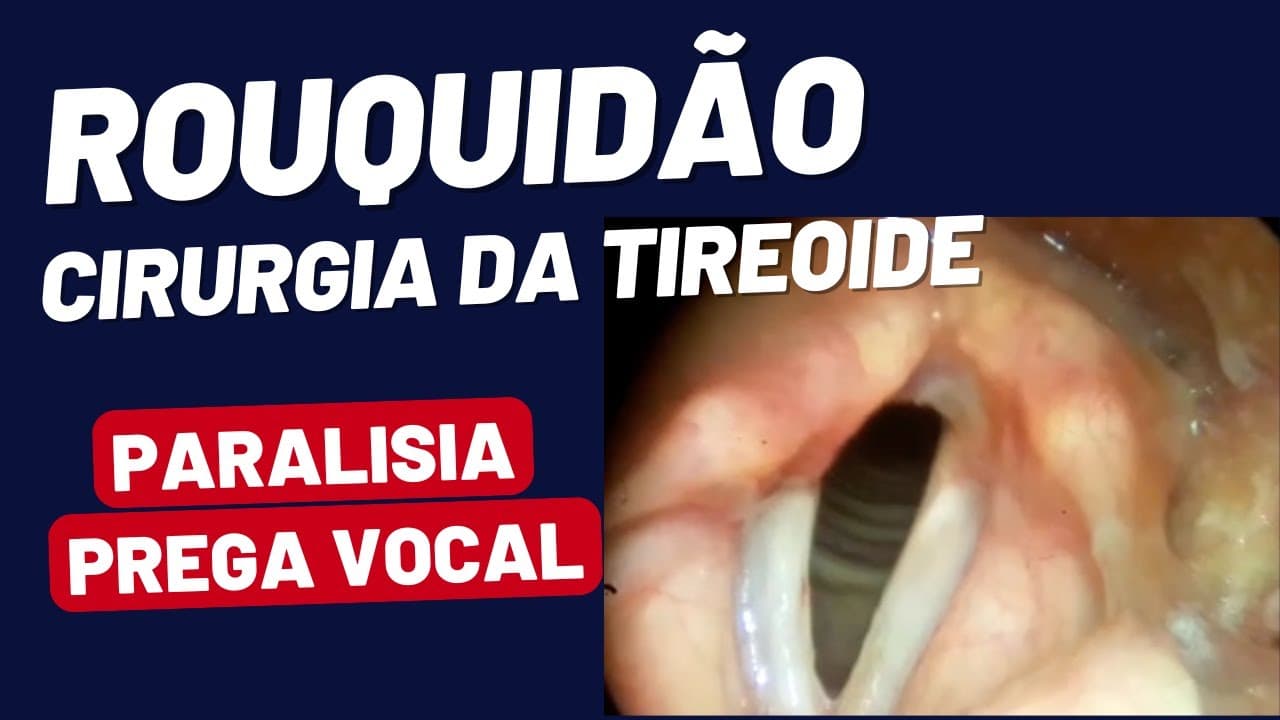 Paralisia de Prega Vocal após Tireoidectomia: O que a Laringoscopia Revela?