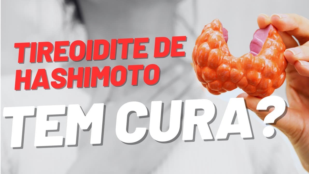 Tireoidite de Hashimoto tem cura?