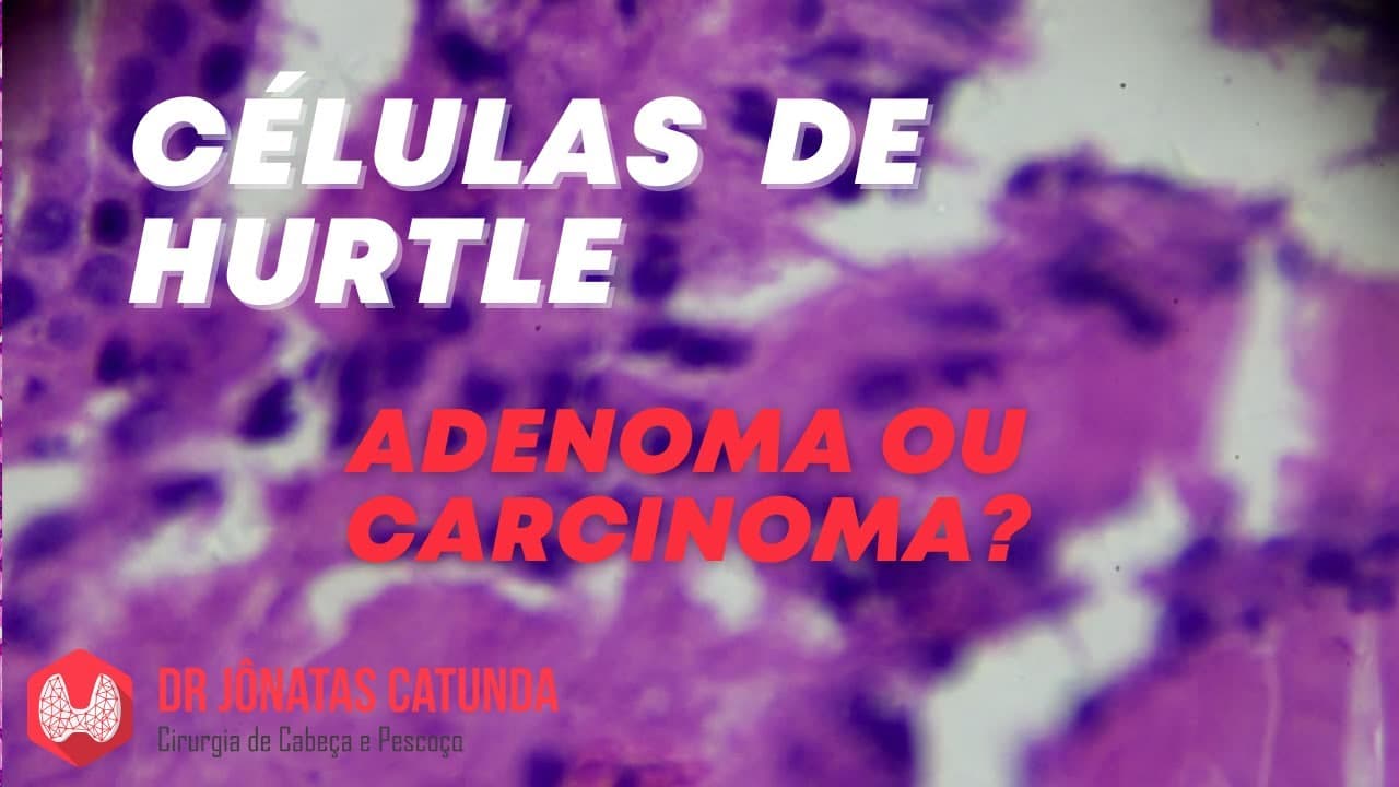 Células de Hurtle - Bethesda IV: Neoplasia folicular, adenoma ou carcinoma?