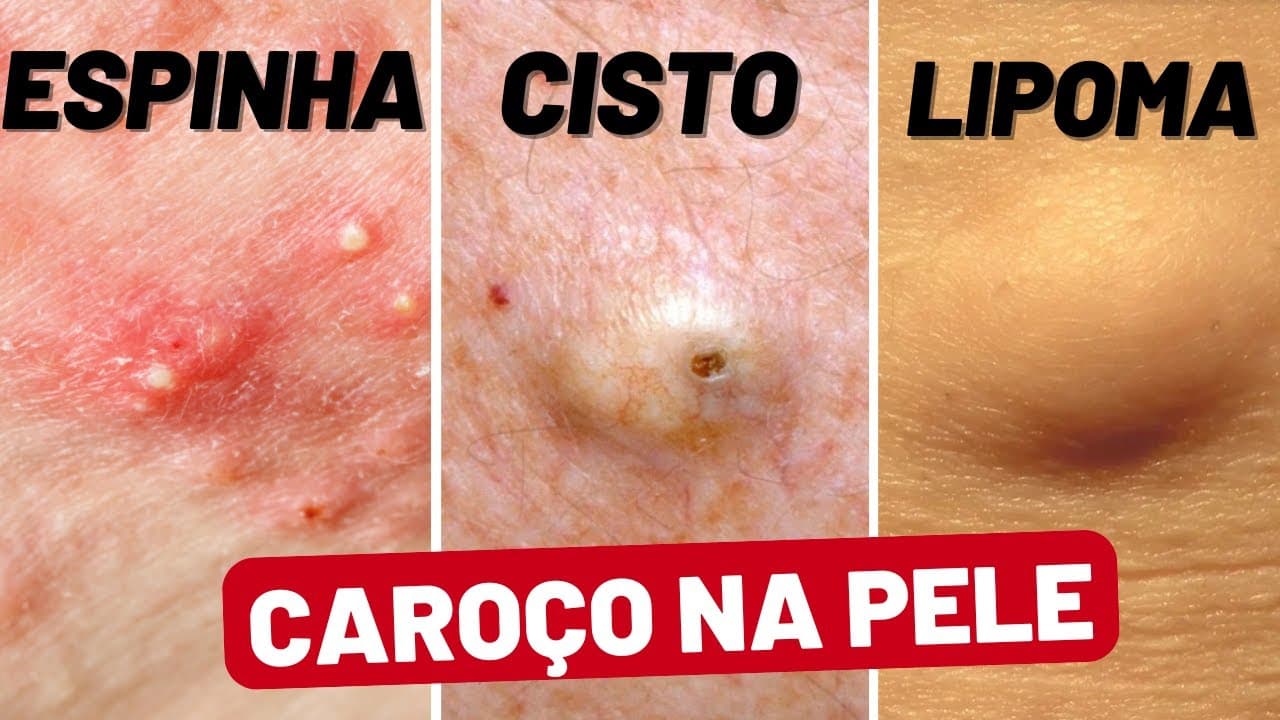 Caroço na pele: cisto, espinha ou lipoma?