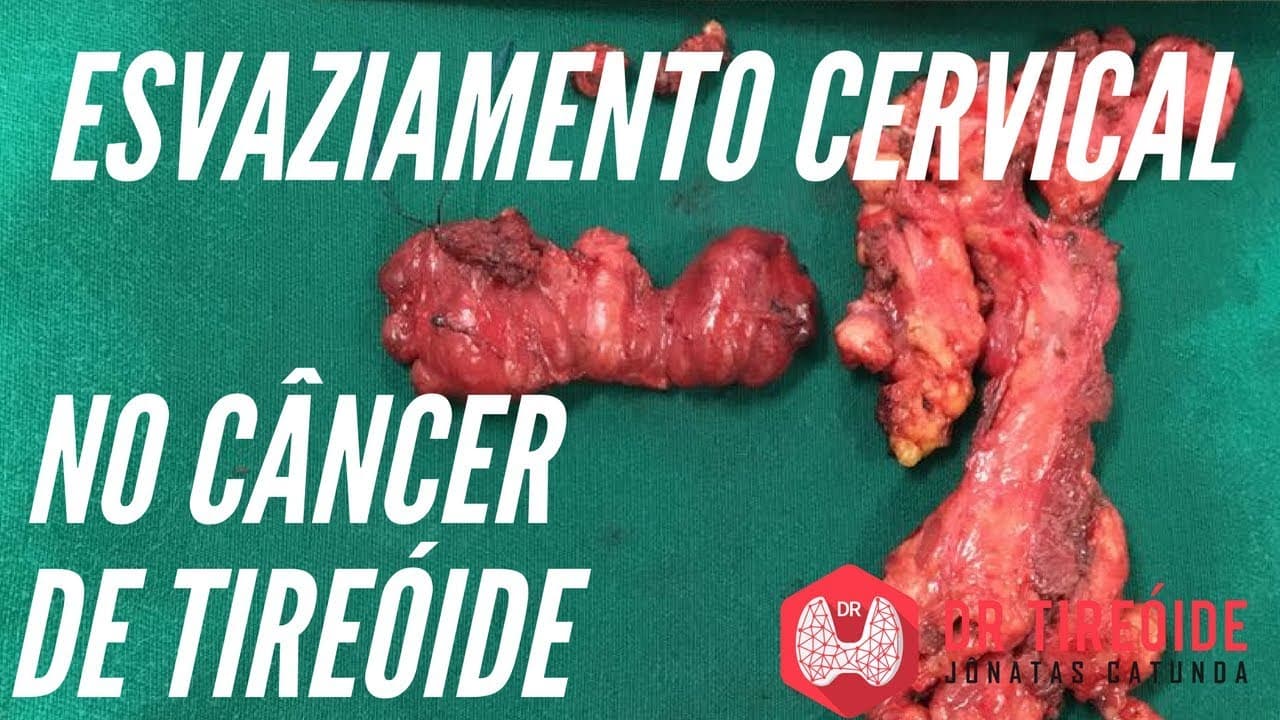 Esvaziamento cervical no câncer de tireóide | Dr Jônatas Catunda