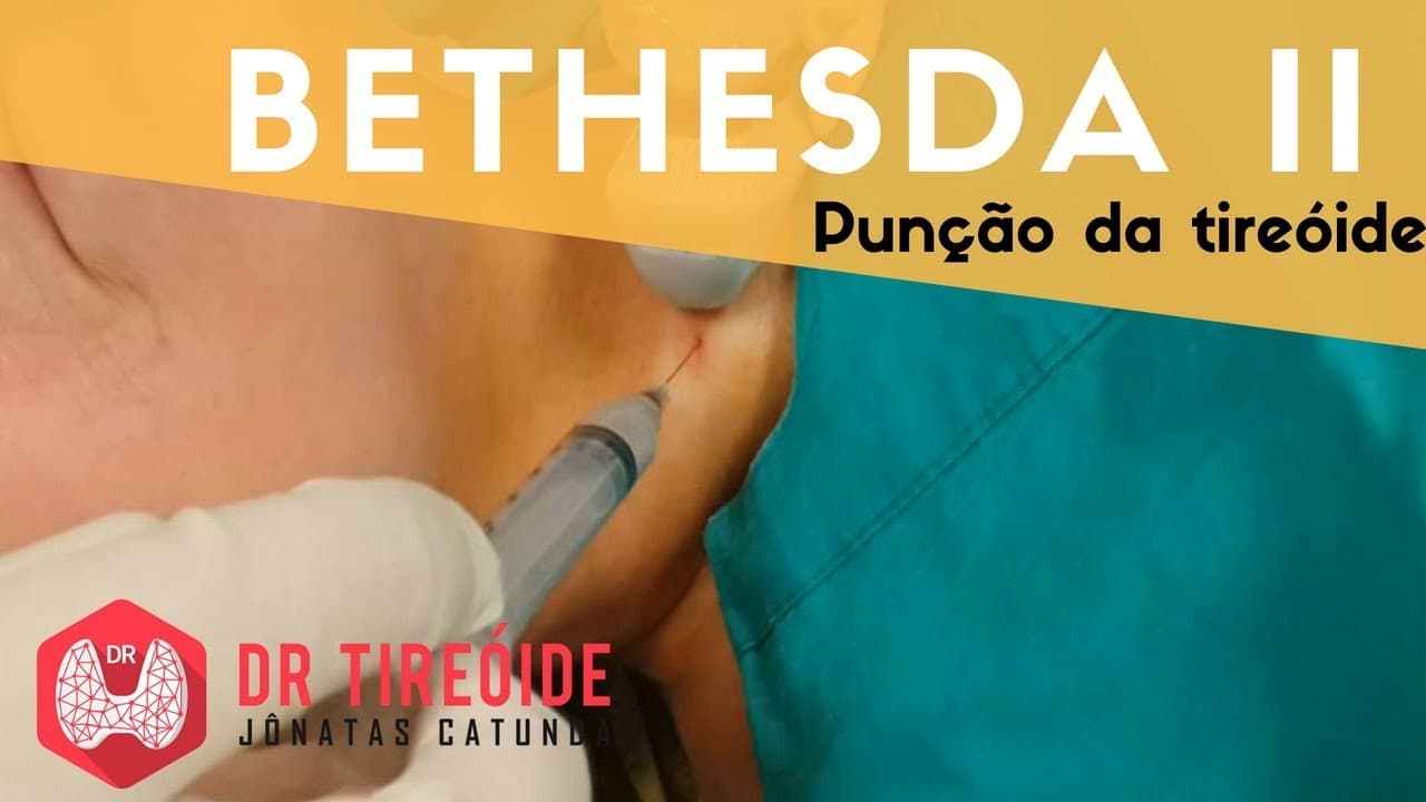 PAAF da tireóide Bethesda II - Resultado BENIGNO!!! | Dr Jônatas Catunda