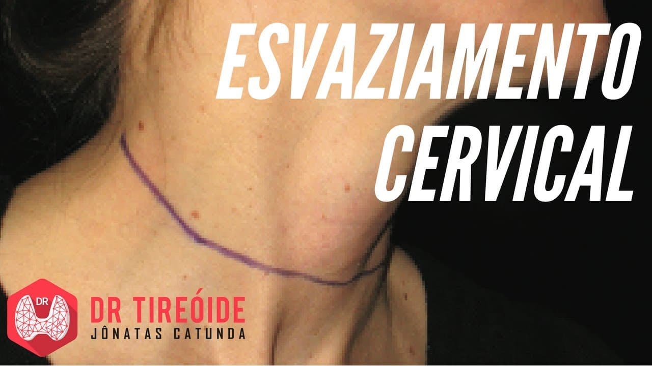 Esvaziamento Cervical | Dr Jônatas Catunda