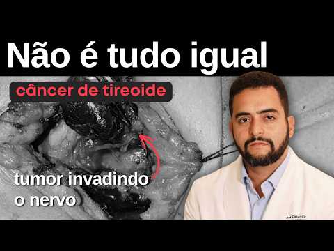 Câncer de tireoide: por que alguns casos preocupam mais do que outros?