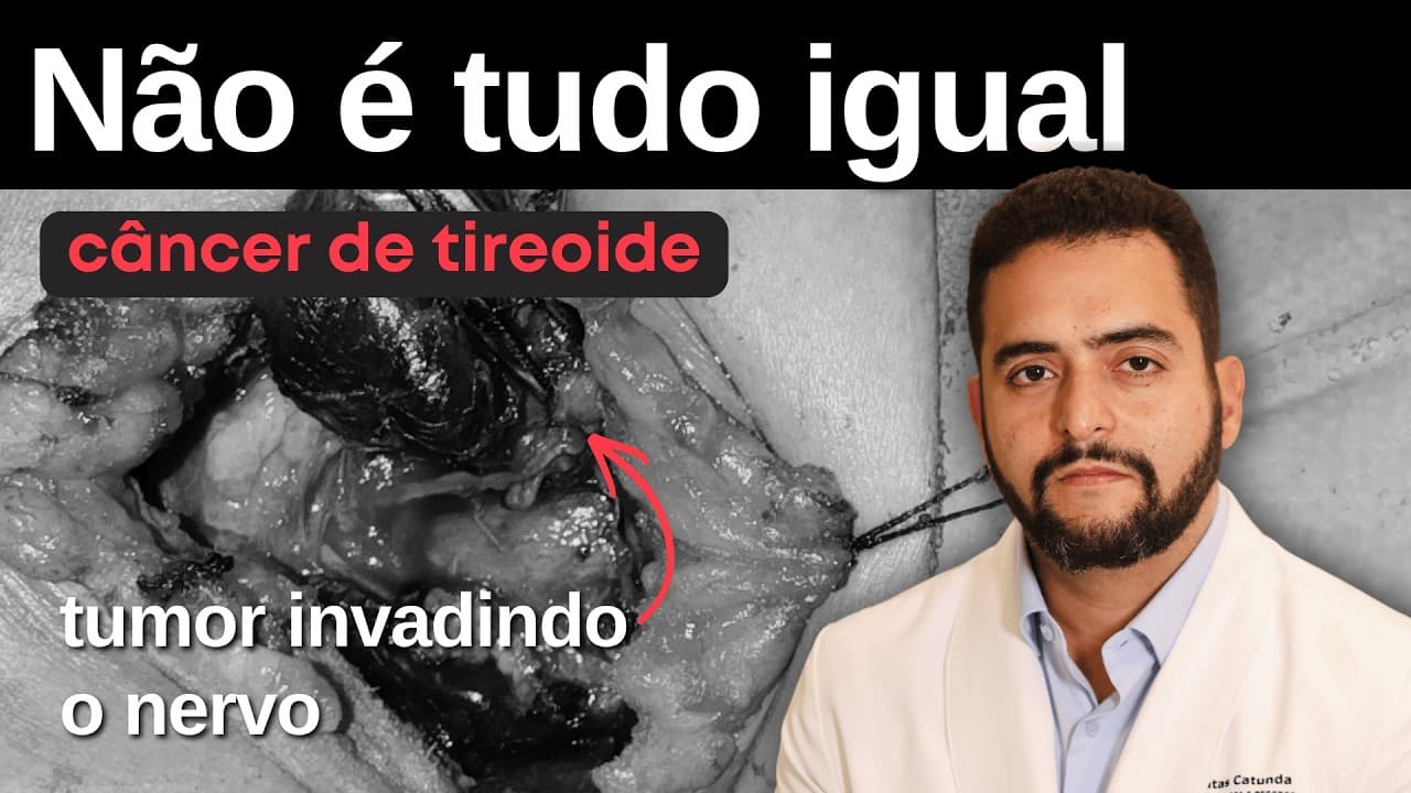 Câncer de tireoide: por que alguns casos preocupam mais do que outros?