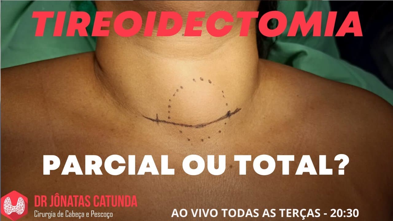 Tireoidectomia parcial ou total?