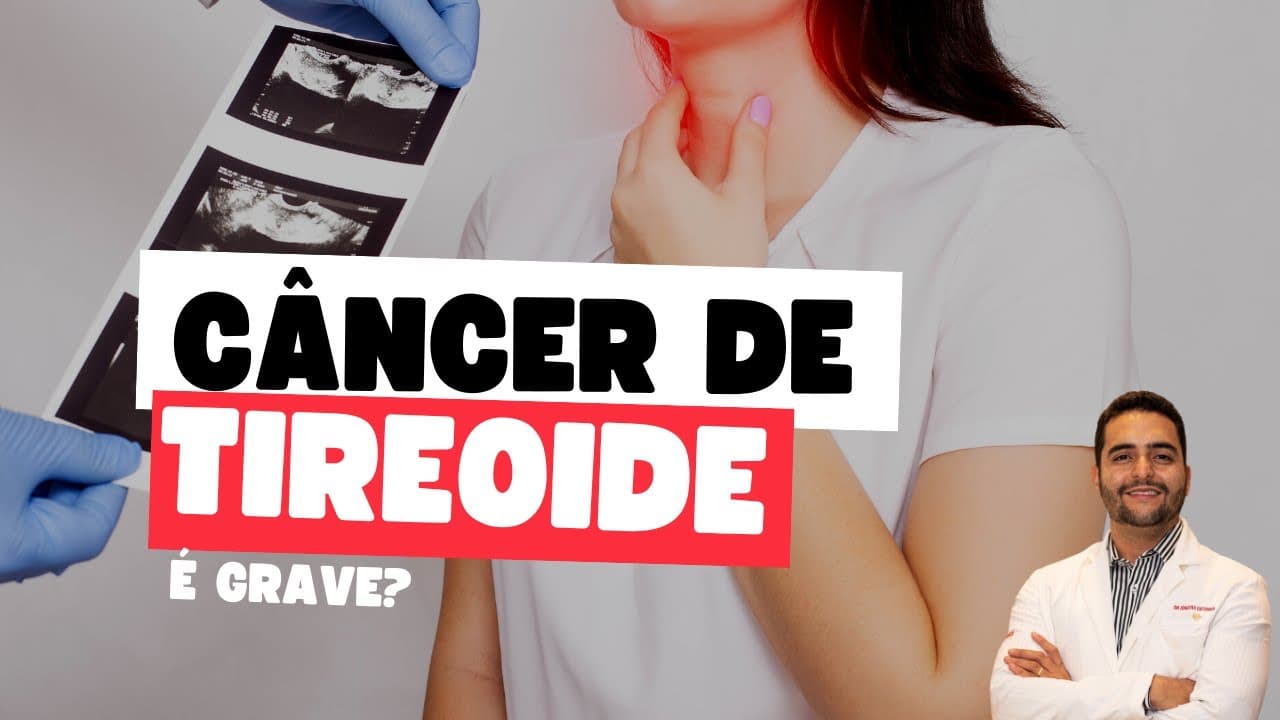 Câncer de tireoide é grave? Dr Jônatas Catunda Cirurgião de cabeça e pescoço