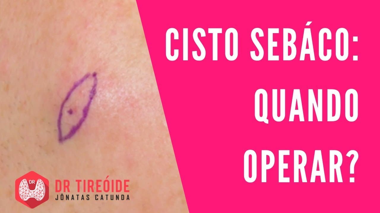 Cisto sebáceo: Quais casos terão que fazer cirurgia? Dr Jônatas Catunda