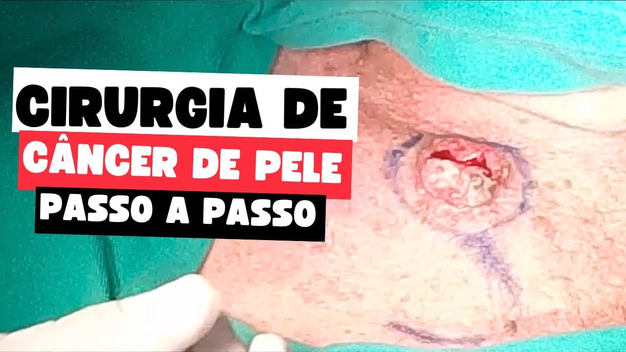 Cirurgia de câncer de pele passo a passo: remoção + reconstrução com retalho