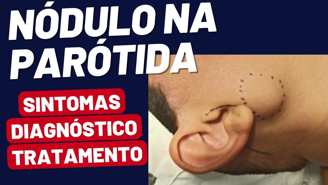 Nódulo na Parótida: Conheça as Opções de Tratamento