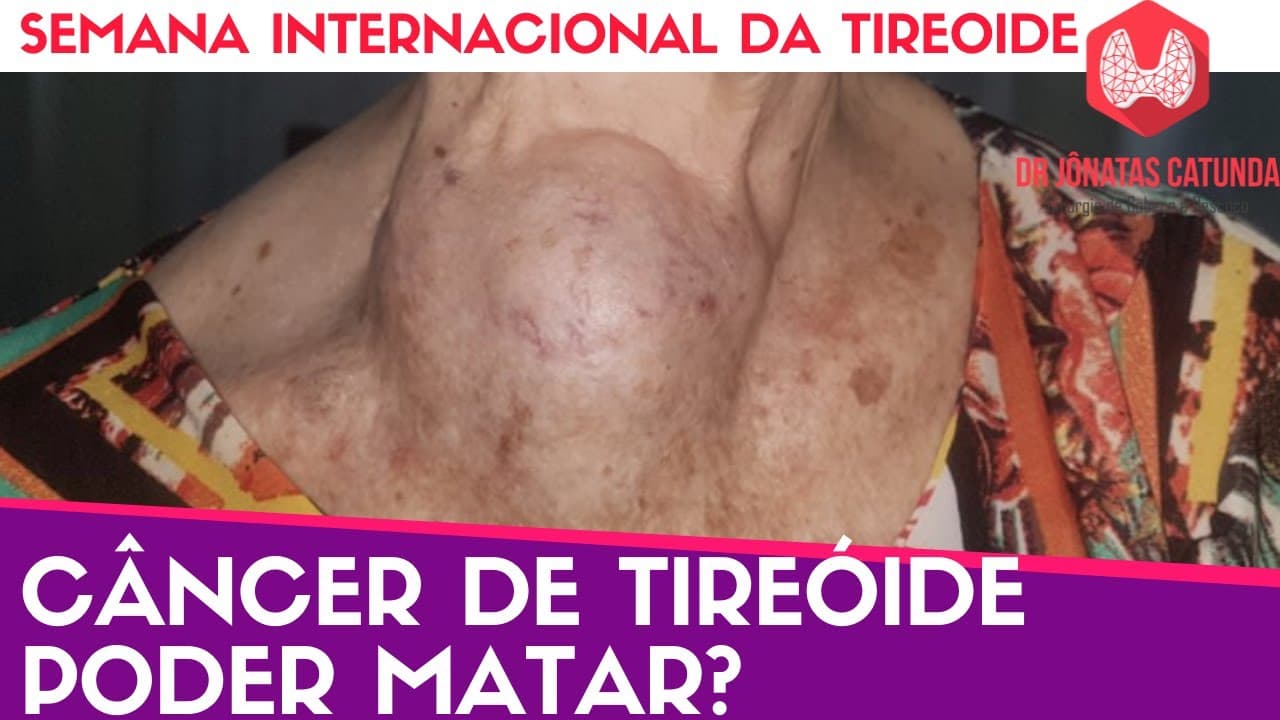 Câncer de tireoide pode matar? - Semana internacional da tireoide