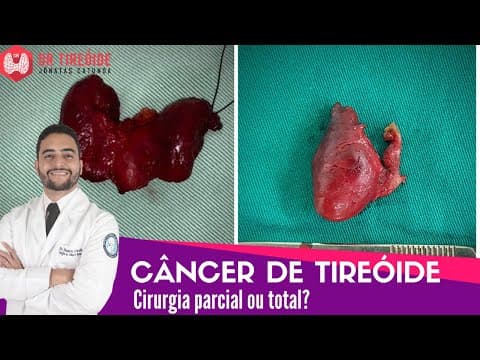 Câncer de tireóide - cirurgia parcial ou total? - Dr Tireóide responde