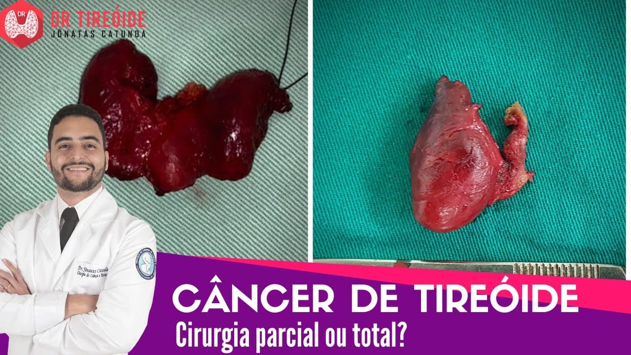 Câncer de tireóide - cirurgia parcial ou total? - Dr Tireóide responde