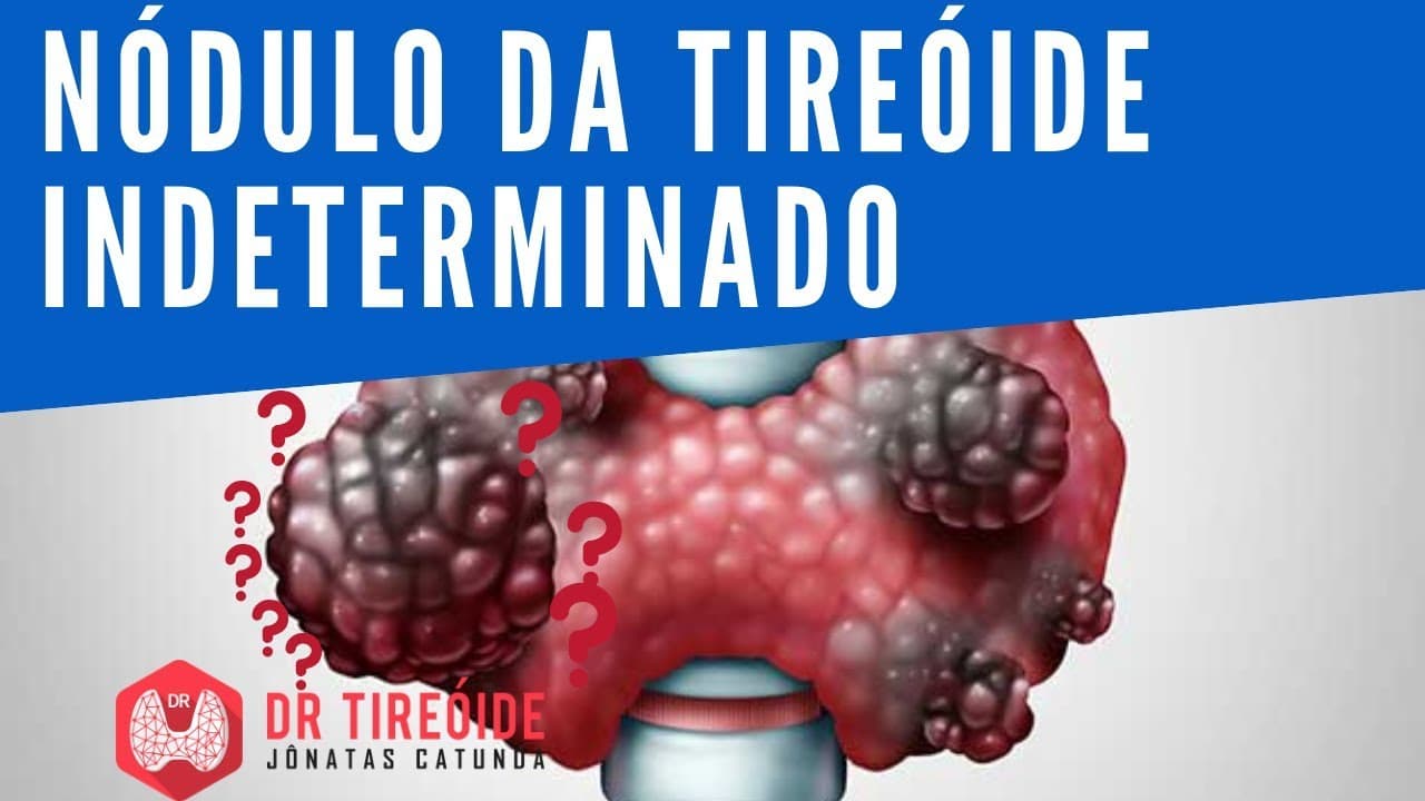 Nódulo da tireóide indeterminado - Dr Tireóide Responde