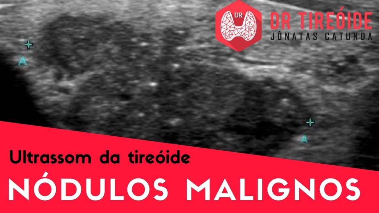 Ultrassom da tireóide - Nódulos malignos! | Dr Jônatas Catunda