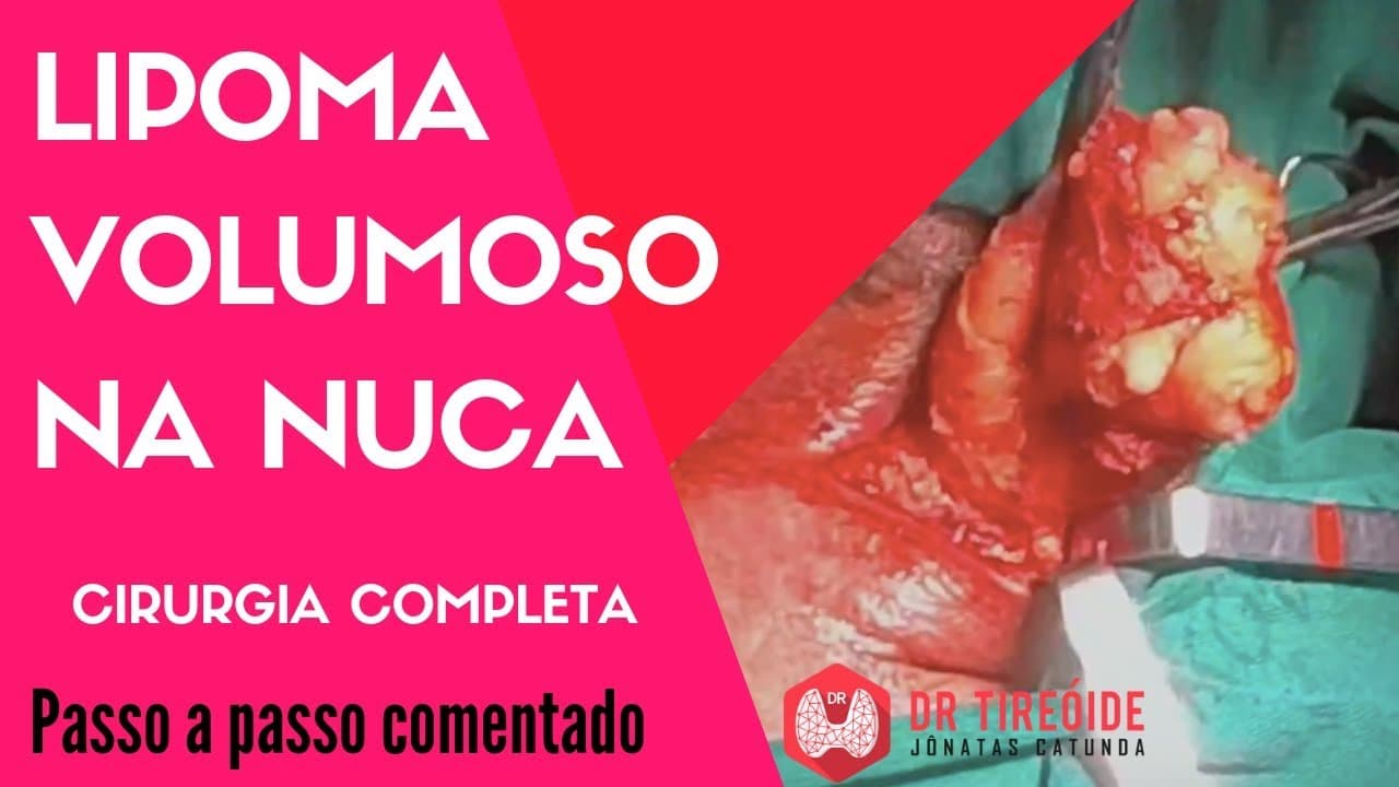 Cirurgia para retirar um lipoma volumoso - Cirurgia Passo a passo | Dr Jônatas Catunda