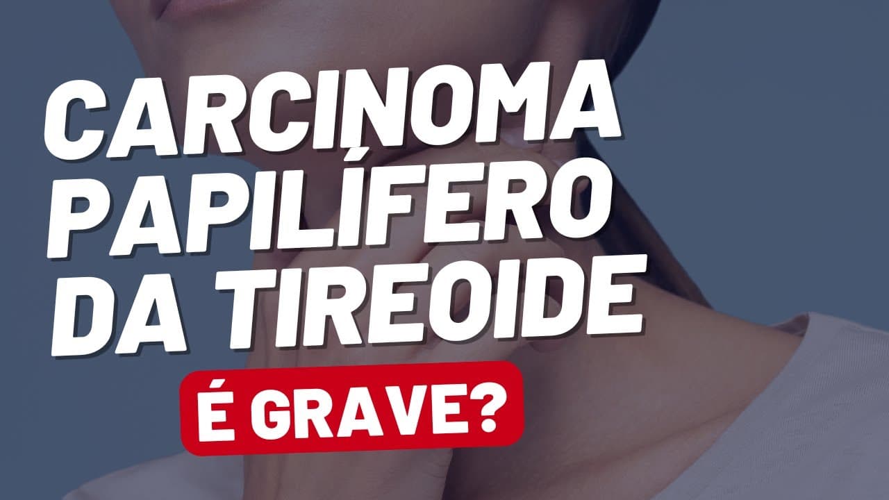 Carcinoma Papilífero de Tireoide: o Câncer Mais Comum da Tireoide!