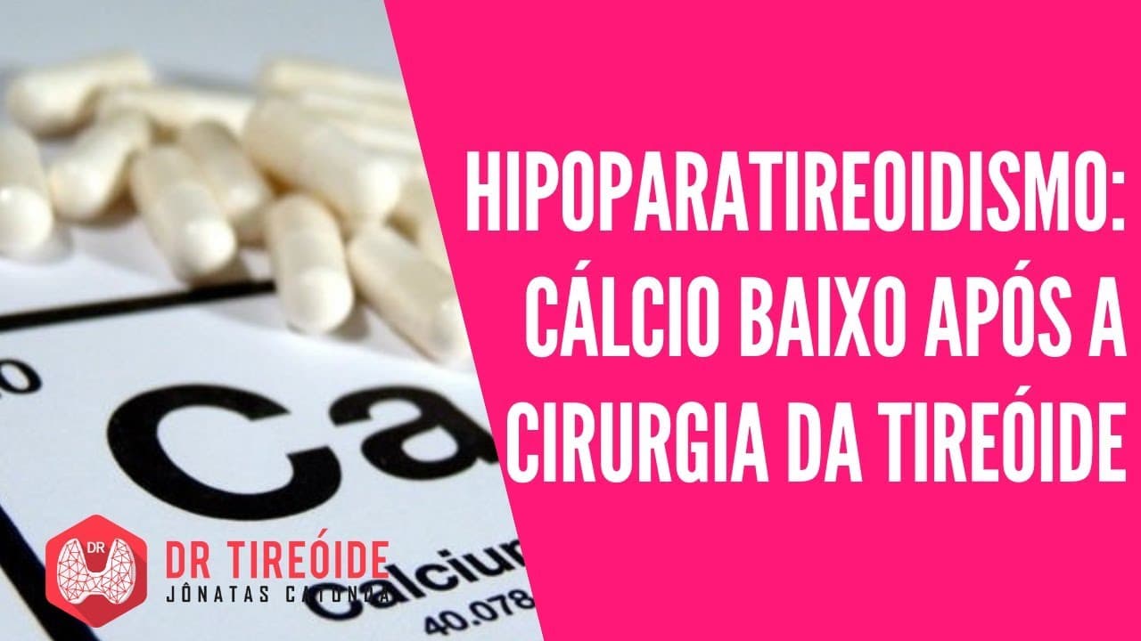 Hipoparatireoidismo: cálcio baixo após a cirurgia da tireóide | Dr Jônatas Catunda