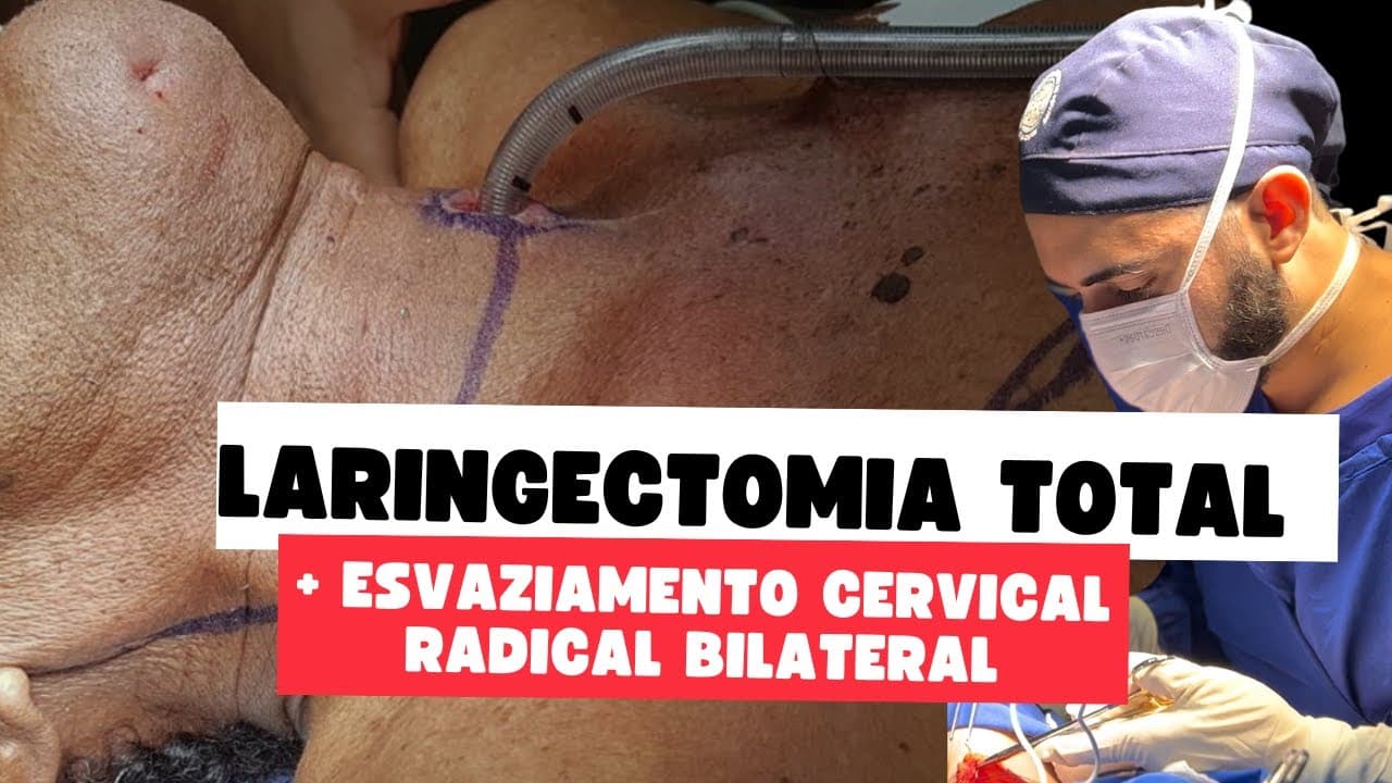 Comentários sobre câncer avançado de laringe - Laringectomia total com esvaziamento cervical radicla