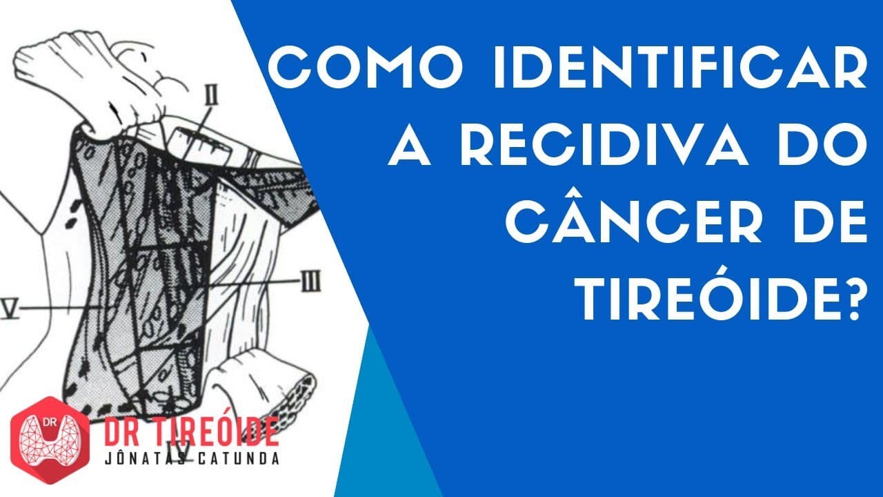 Como identificar a recidiva do câncer de tireóide? | Dr Tireóide Responde