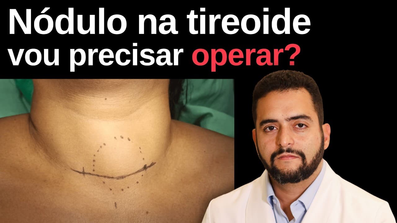 Você tem nódulo na tireoide? Veja quais casos tem indicação de cirurgia
