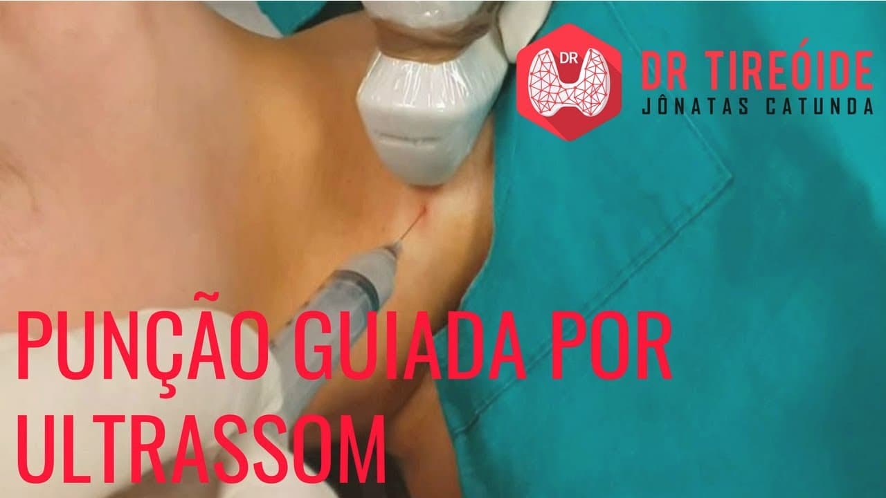Punção guiada por ultrassom, a PAAF - Entenda como é feito essa biópsia!