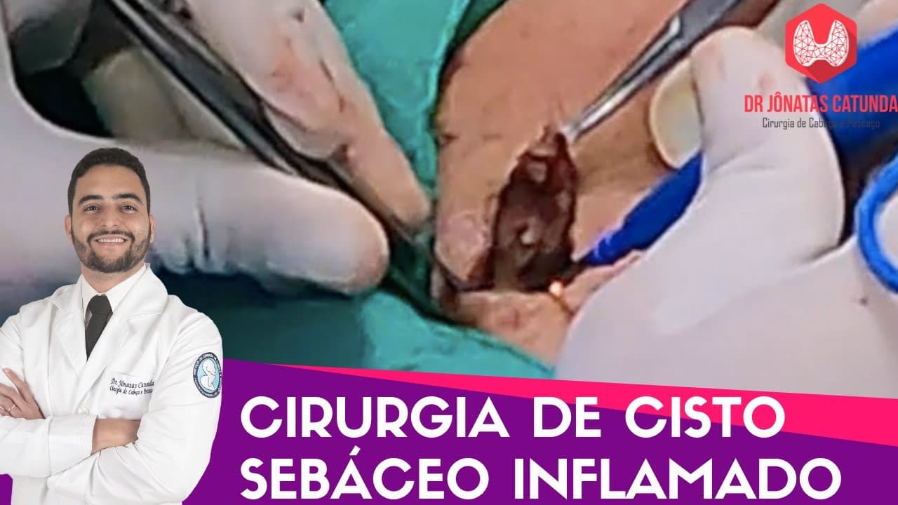 Cisto sebáceo inflamado - cirurgia filmada