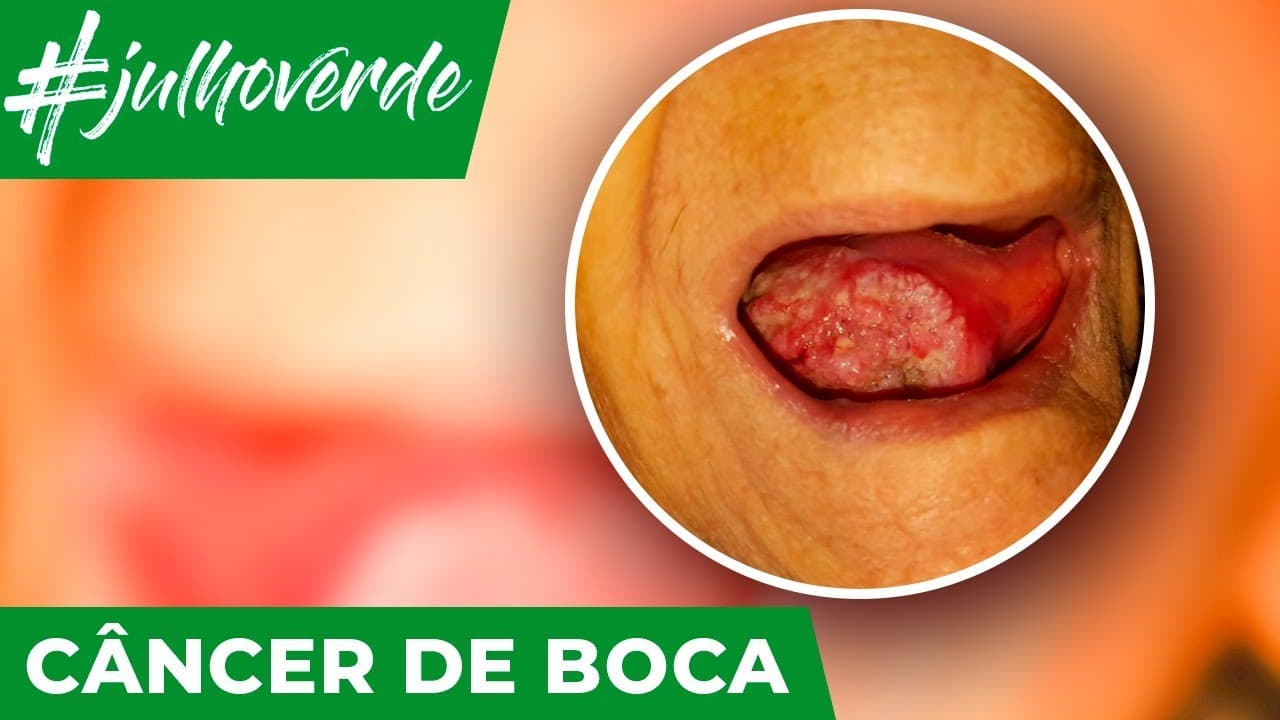 Informações importantes sobre o câncer de boca | Campanha Julho Verde