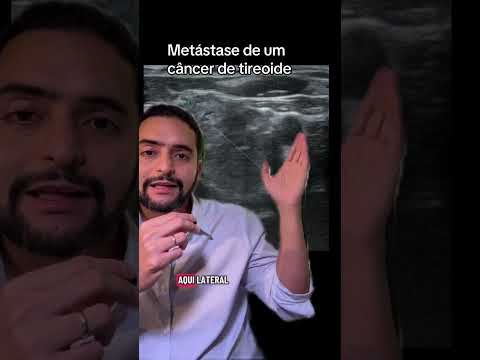 Câncer de tireoide com metástase em linfonodo do pescoço: o que muda