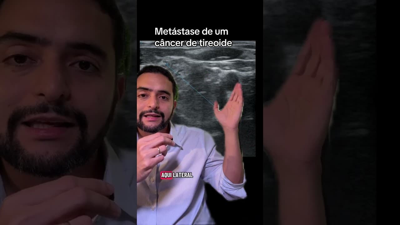 Câncer de tireoide com metástase em linfonodo do pescoço: o que muda